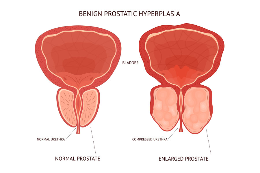 Enlarged Prostate