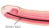 Peyronie's graphic 01