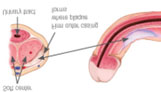 Peyronie's graphic 03